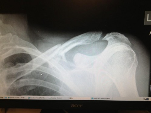 DavidLionXray X-ray of David Lion Rattiner's broken clavicle bone