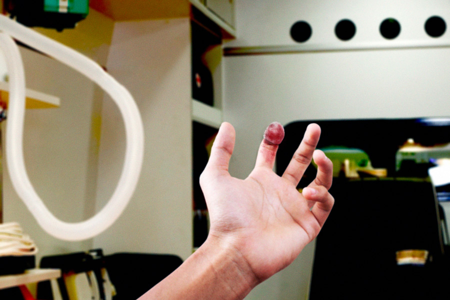 Derwood Hodgegrass shared this sefie after losing his fingertip on Sunday