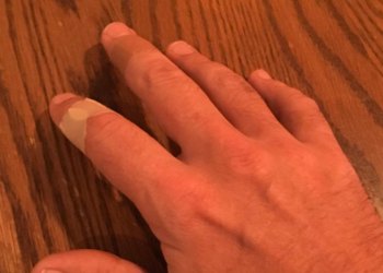 Jimmy Fallon injures a finger, again!