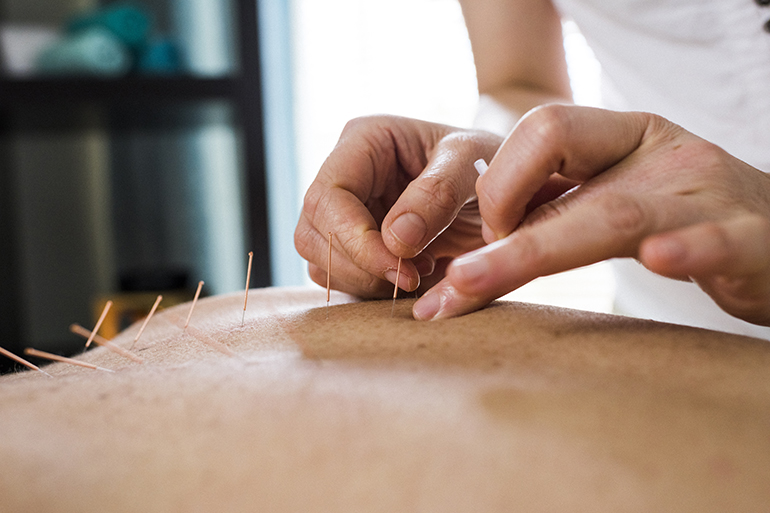 Photo of woman having acupuncture treatment. Alternative Medicine.