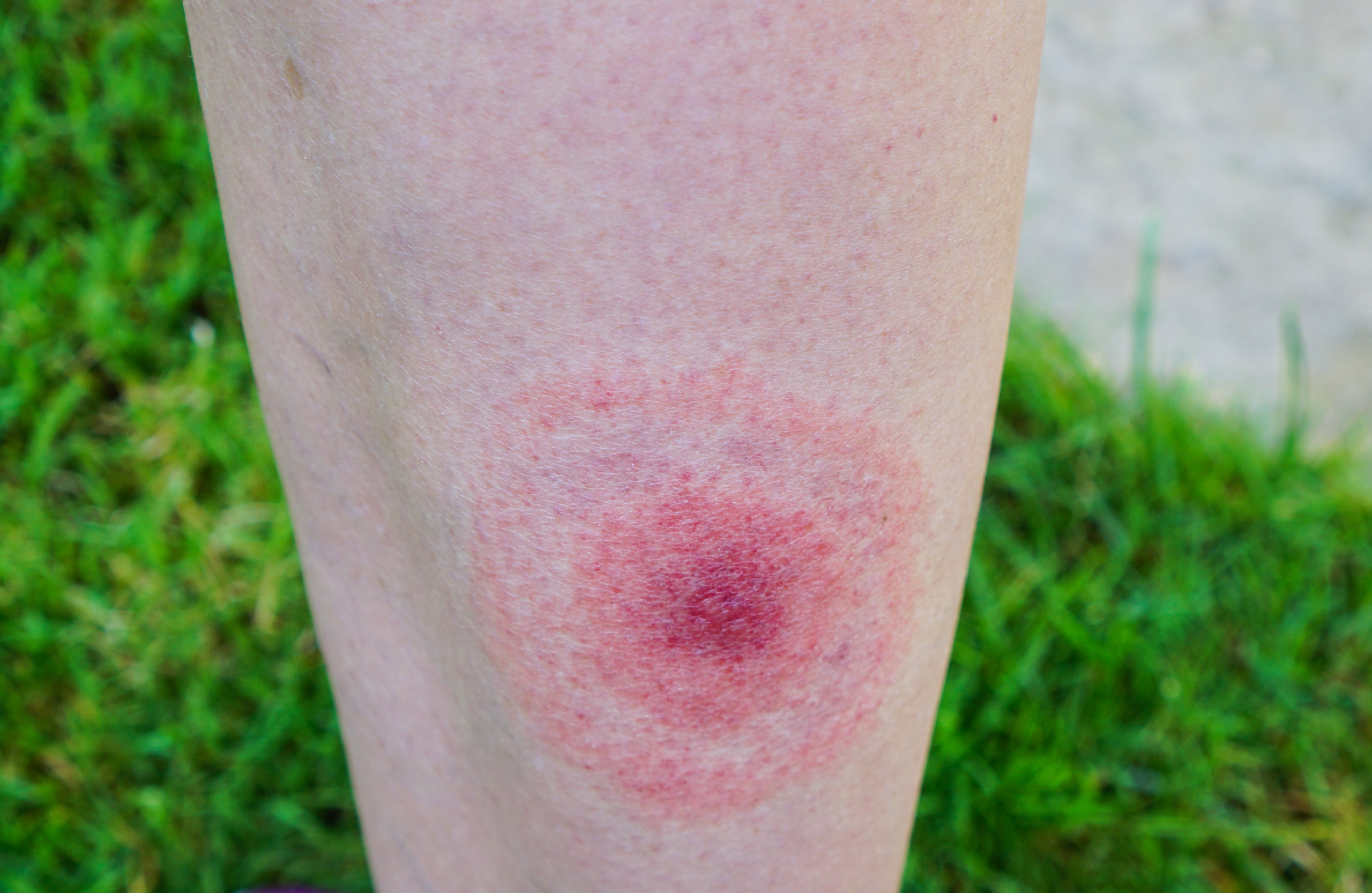 A classic Lyme disease "bullseye" rash, which is not as common as people might think