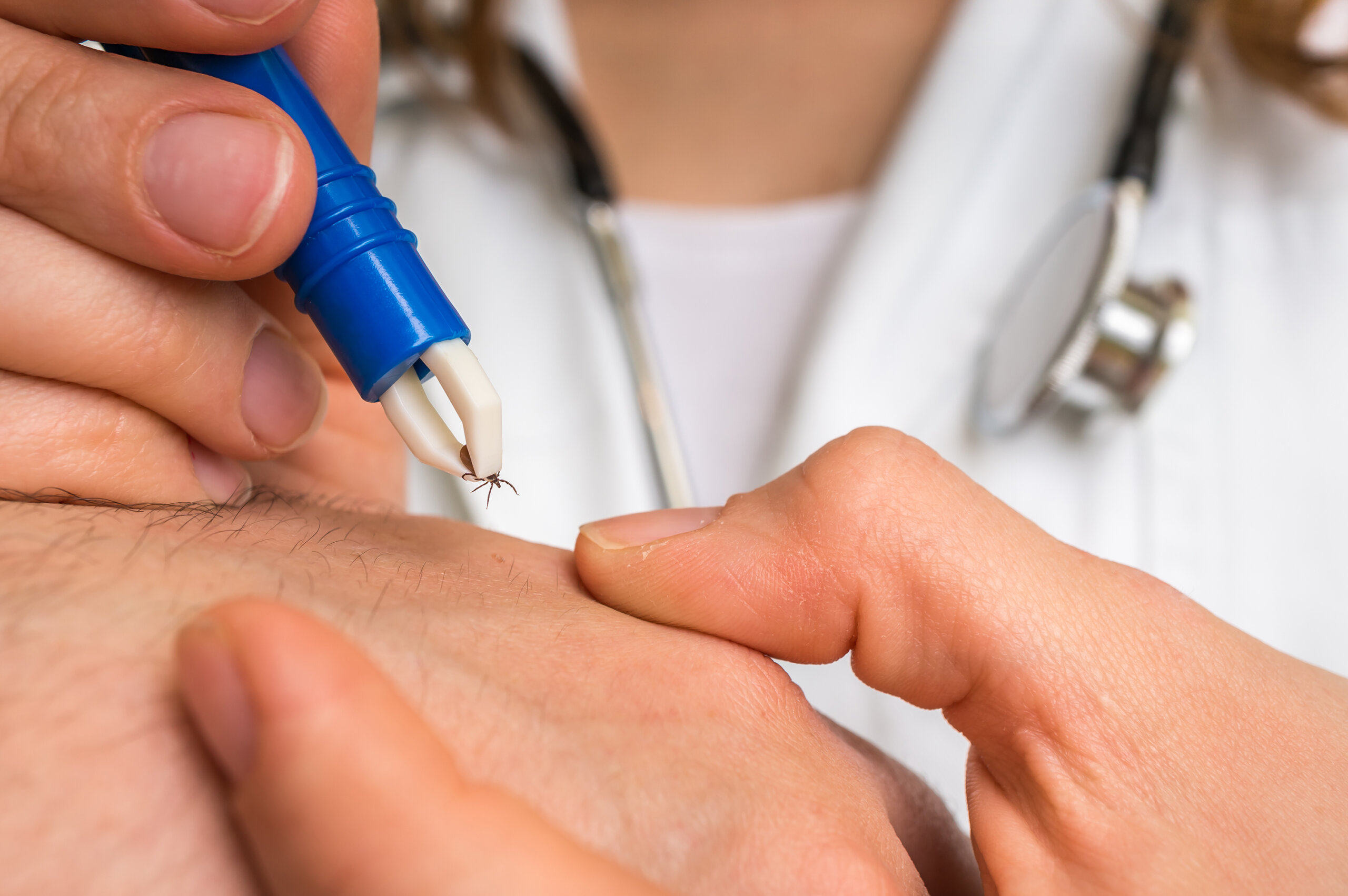 Female doctor removing a tick with tweezers from hand of patient to prevent tick-borne disease - Encephalitis, borreliosis and lyme disease.